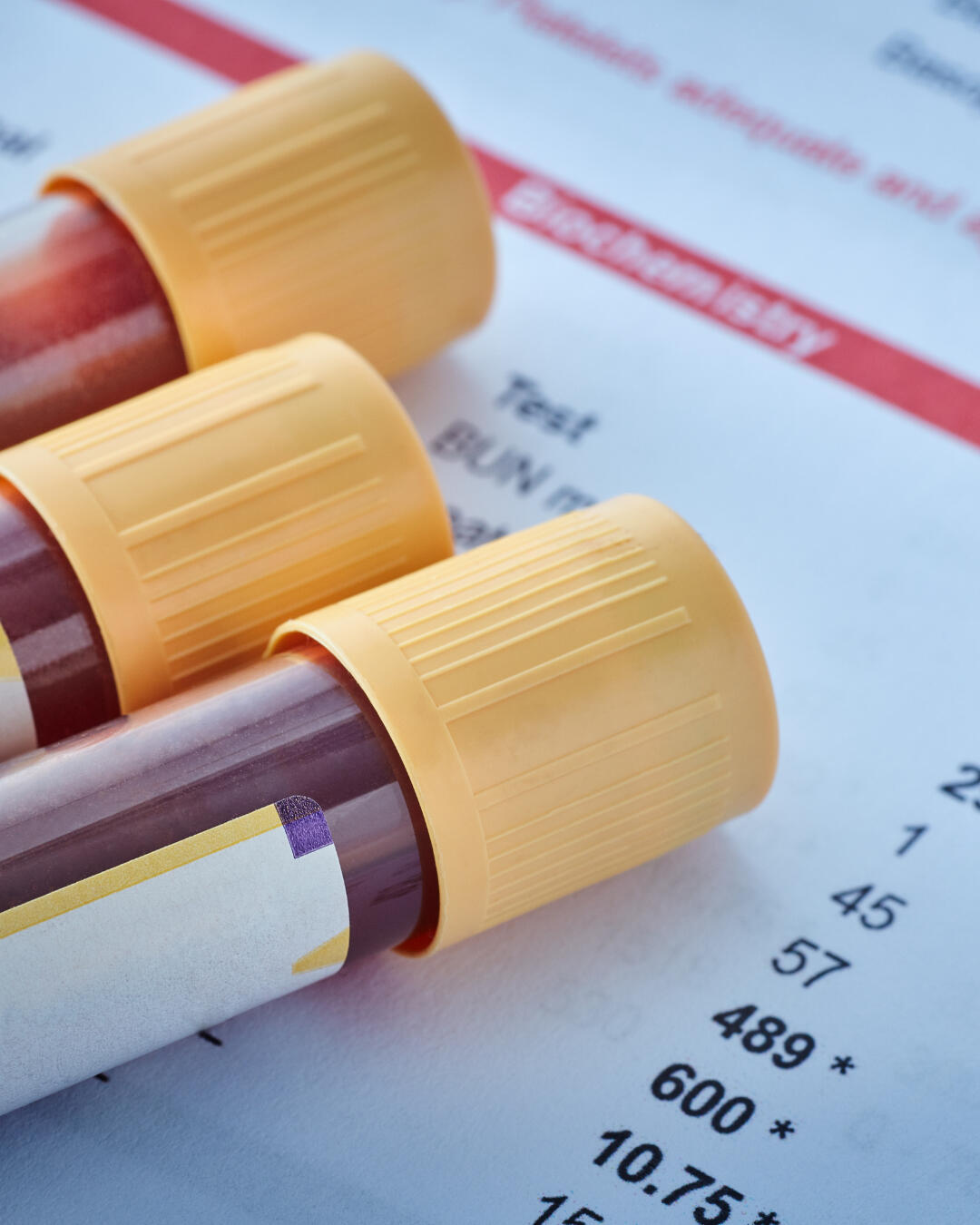 Blood Sample Tubes for Laboratory Testing Close-up of yellow-capped blood collection tubes placed on a printed lab results sheet
